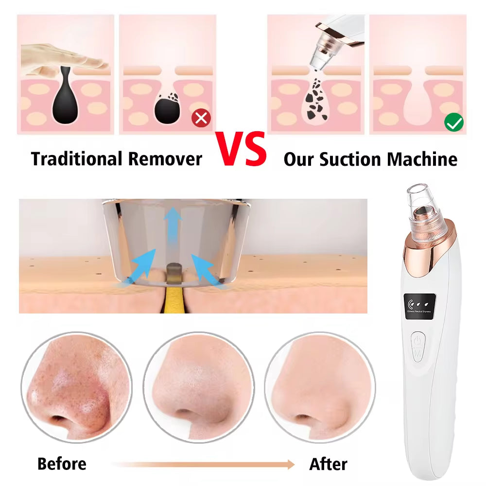 Electric Blackhead Remover with Vacuum Suction sick care tool